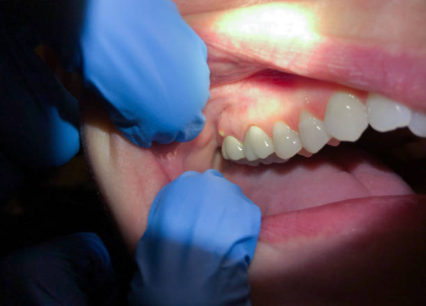Best Emergency Dentist for Knocked-Out Tooth in Piqua, OH